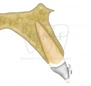 Diente de perfil con bracket de ortodoncia